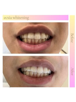 エクシアホワイトニング 秋田大町店/ビフォーアフター