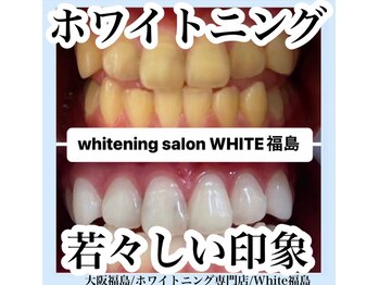 ホワイトニングサロン ホワイト(WHITE)/セルフホワイトニング/大阪/福島