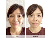 サロン レインボー(SALON RAINBOW)/小顔単発メニュー　Before/After