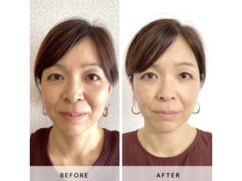 サロン レインボー(SALON RAINBOW)/小顔単発メニュー Before/After