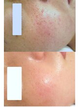 サロンドエステケイワイ(de KY)/フェイシャル☆ニキビ改善