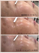 シャンディ(Shandy)/韓国式肌管理ラミピール☆続変化