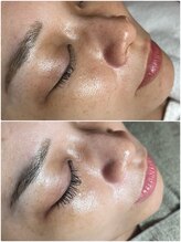 スパークル/美白/毛穴/フェイシャル