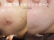 ビーピー 渋谷(b.p.)の雰囲気(毛穴、ニキビケア、敏感肌、赤み ハーブピーリング 渋谷)