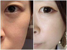 トリニティスペース(TrinitySpace)/美白カクテル×プラズマ