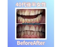 ホワイトニングショップ 西原店/40代後半女性☆BeforeAfter