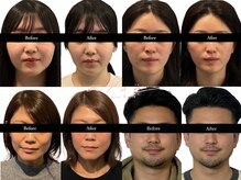 アロエベル(aloe Belle)/Before After集