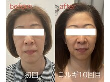 ビーキュート 姫路店(BE-CUTE)/小顔コルギ10回目