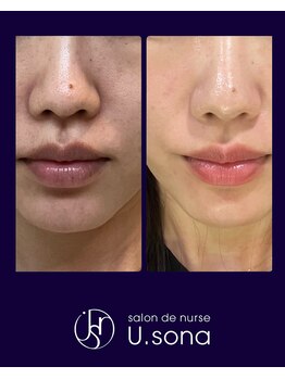 小顔・脂肪コントロール専門 salon de nurse U.sona～松本店～/【韓国基礎化粧品で肌質改善】