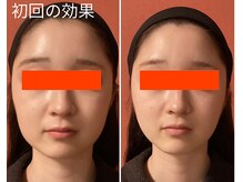 ロイヤリティ(ROYALTY)/エラ張りにも効果あり！