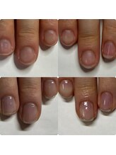 マニュコクーン(ManuCocoon)/爪育成　深爪　巻き爪　大阪市