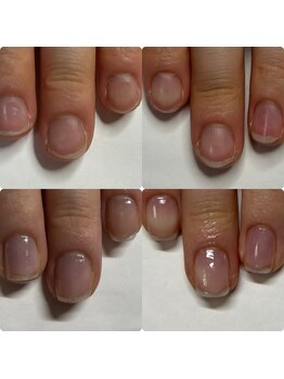 マニュコクーン(ManuCocoon)/爪育成 深爪 巻き爪 大阪市