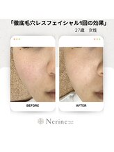 ネリネ(Nerine)/20代からのケアが大切です