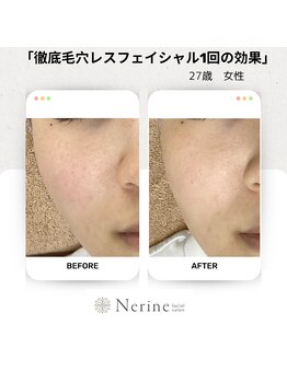 ネリネ(Nerine)/20代からのケアが大切です