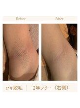 ガムラン(Gamelan)/ワキ脱毛　2年フリー（右側）