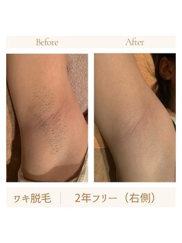 ガムラン(Gamelan)/ワキ脱毛　2年フリー（右側）