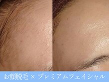 オーシャンブルー 大分店(OCEAN BLUE)/顔脱毛×プレミアムフェイシャル