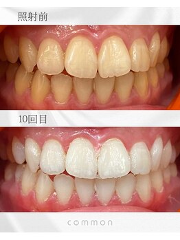 セルフホワイトニングコモン 藤枝店(self whitening common)/10日間ベーシックコース