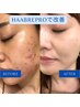 【超絶おススメNo.1】HAABREPROハーブピーリング（1週間プログラム）