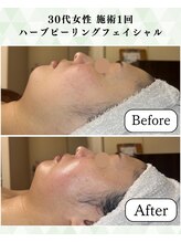 シーフェイス 横浜店(SEE FACE)/肌のハリツヤアップ！くすみ改善