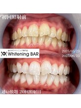 ホワイトニングバー 町田店/通い放題ビフォーアフター