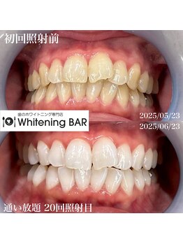 ホワイトニングバー 町田店/通い放題ビフォーアフター