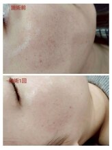 縁(en)/ニキビ集中ケア1回☆