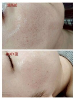 縁(en)/ニキビ集中ケア1回☆