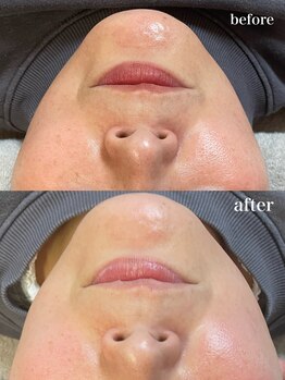 ニコリ(Nicori)/シェービングエステ