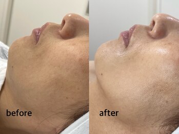 Olu【オル】肌質改善サロン. ハーブピーリング/クリスティーナ/クリスティーナトリートメント