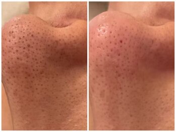 メゾンリュバン 天王寺(Maison Ruban)/毛穴洗浄・美白フォト|毛穴ケア