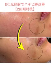 フレイヤビューティー スハダラボ 恵比寿(Freyia Beauty Suhada LABO)/-IPL光フェイシャル-