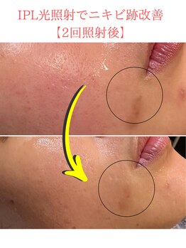 フレイヤビューティー スハダラボ 恵比寿(Freyia Beauty Suhada LABO)/-IPL光フェイシャル-