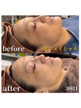 グレイスボディ BiViつくば店(Grace Body)/光フェイシャル症例写真