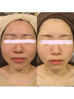 アユアランリンク 札幌店/半年で肌荒れ軽減！