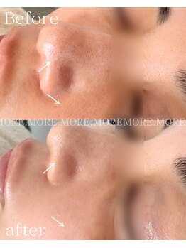 モア 吉祥寺(MORE.)/BeforeAfter