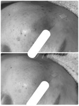 エルール トータルビューティ(Aileure total beauty)/シミケア