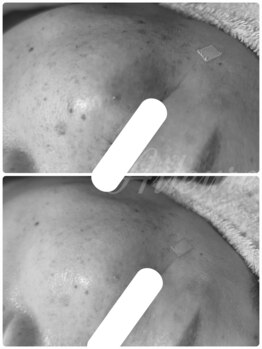 エルール トータルビューティ(Aileure total beauty)/シミケア