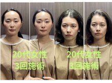 ハナレ(HANARe)/美容鍼/２０代女性