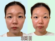 ナチュラルパーフェクトフェイス 新宿/3回目はタルミ／新宿小顔矯正