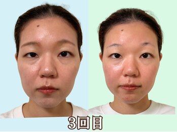 ナチュラルパーフェクトフェイス 新宿/3回目はタルミ／新宿小顔矯正