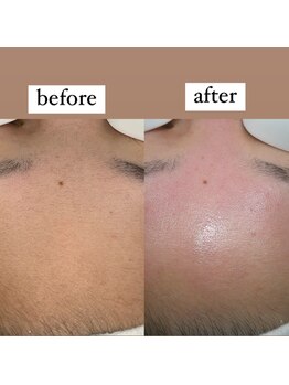 テンパ ビューティー(+10%beauty)/一撃タマゴ肌ワックス