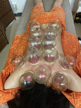 りゅう中国整体院 自由が丘の写真/むくみ改善には吸玉(カッピング）がおすすめ!血行促進し冷え改善、デトックスや筋肉痛の改善、代謝UPにも◎