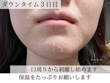 ナナ(nana)/ハーブピーリング｜ダウンタイム