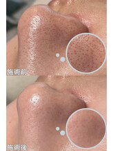 クレアナ ザ ビューティー(KULEANA the beauty)/毛穴クレンジング