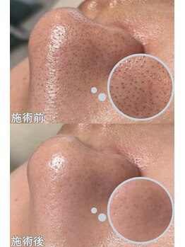 クレアナ ザ ビューティー(KULEANA the beauty)/毛穴クレンジング