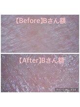 バルーサヤ 吉祥寺(Baru Saya)/Before-After Bさん額（４０代）