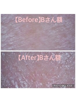 バルーサヤ 吉祥寺(Baru Saya)/Before-After Bさん額（４０代）