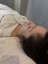 ジョア(joie)/美容鍼施術