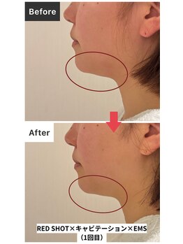 エトワール(etoile)/REDSHOT×ラジオ波×キャビ×EMS